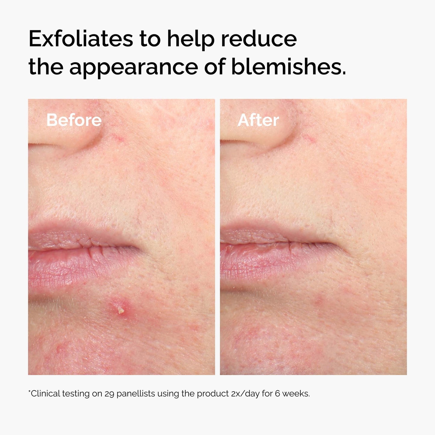 The Ordinary Salicylic Acid 2% Solution