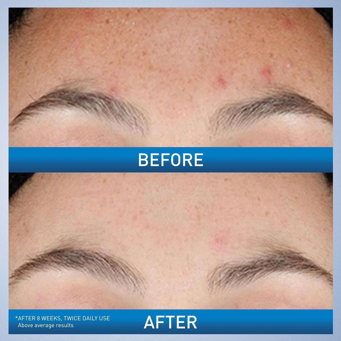CeraVe Resurfacing Retinol Serum – Smooths Skin Texture & Minimizes Pores